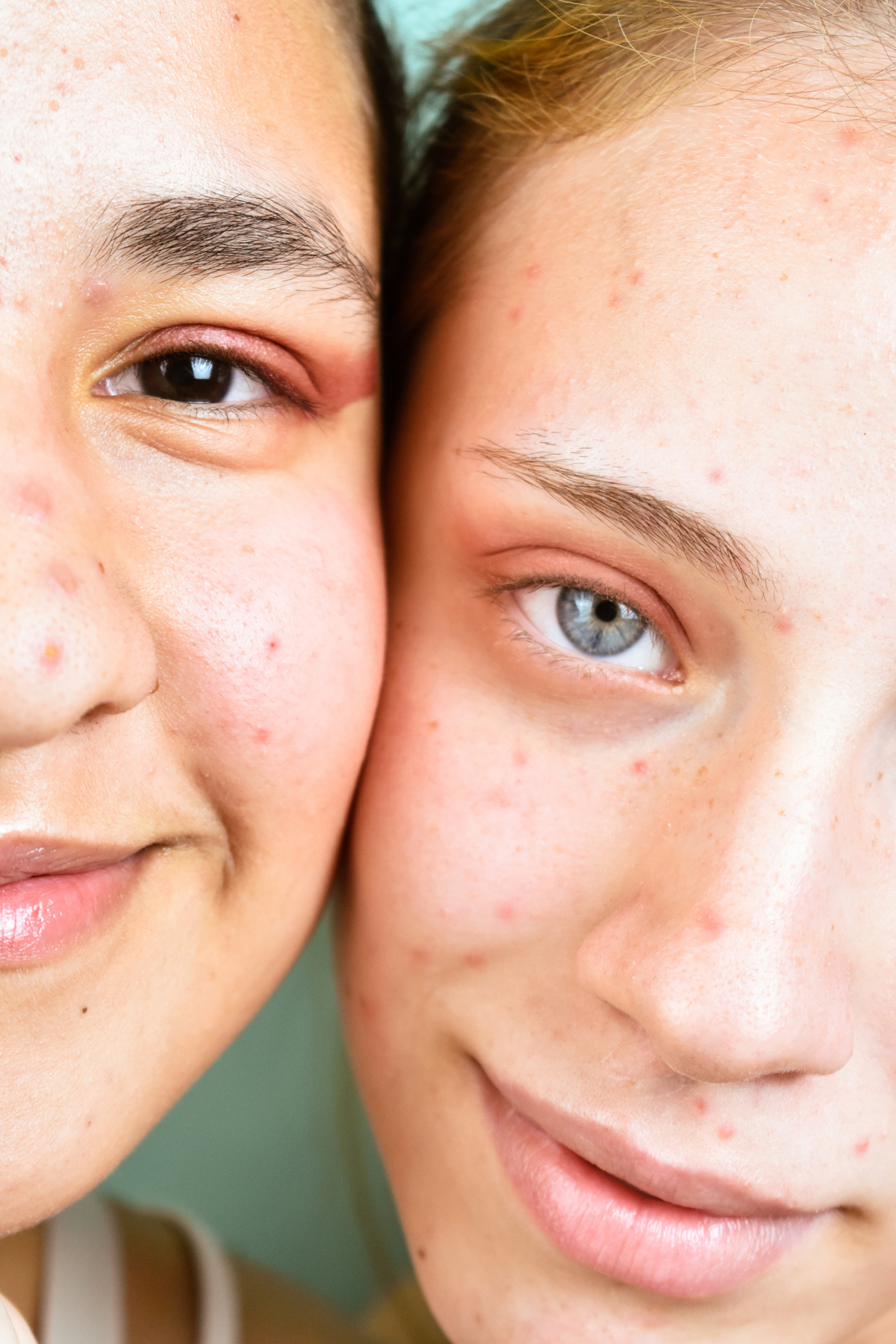 Closeup Shot of Two Women with Freckles and Acne